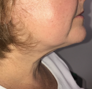 Facetite and Necktite Before and After Pictures in Colorado Springs, CO