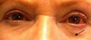 Wrinkle Blocker Before and After Pictures in Colorado Springs, CO
