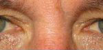 Wrinkle Blocker Before and After Pictures in Colorado Springs, CO