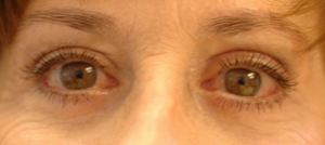 Blepharoplasty Before and After Pictures in Colorado Springs, CO