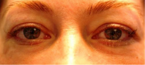 Blepharoplasty Before and After Pictures in Colorado Springs, CO