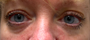 Filler Blepharoplasty Before and After Pictures Colorado Springs, CO