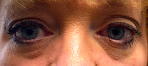 Filler Blepharoplasty Before and After Pictures Colorado Springs, CO
