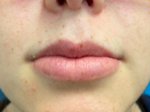 Lip Lift Before and After Pictures Colorado Springs, CO