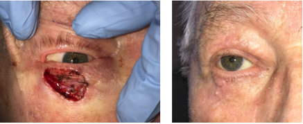 Massive Left Lower Eyelid Reconstruction From Cancer Excision