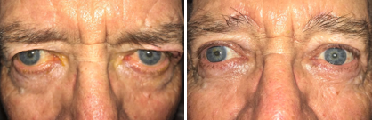 Upper and Lower Eyelid Surgery in Colorado Springs, CO