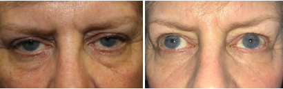 Upper Ptosis Surgery and Retraction Repairs of Lower Eyelids