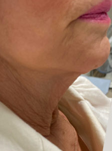 Neck Thread Lift Before and After Pictures Colorado Springs, CO