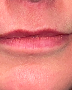 Lip Enhancement Before and After Pictures Colorado Springs, CO