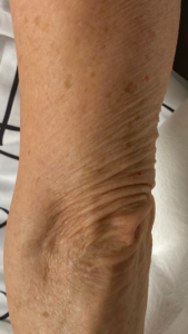 Arm Thread Lift Before and After Pictures Colorado Springs, CO
