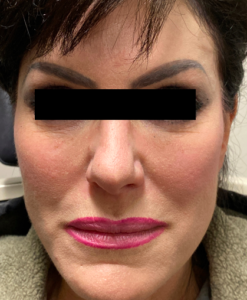 Thread Lift & Filler Before and After Pictures in Colorado Springs, CO