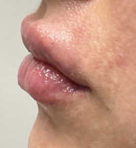 Lip Lift Before and After Pictures Colorado Springs, CO