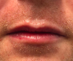Lip Enhancement Before and After Pictures Colorado Springs, CO
