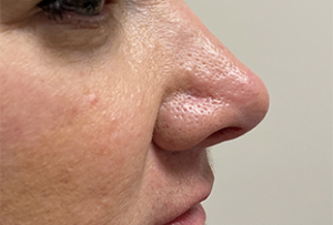 Filler Rhinoplasty Before and After Pictures Colorado Springs, CO