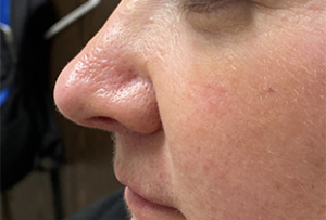 Filler Rhinoplasty Before and After Pictures Colorado Springs, CO