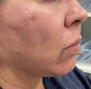 Thread Lift & Filler Before and After Pictures Colorado Springs, CO