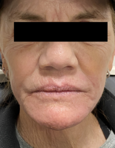 Thread Lift & Filler Before and After Pictures Colorado Springs, CO