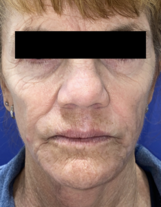 CO2 Laser Skin Resurfacing Before and After Pictures Colorado Springs, CO