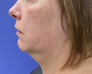 MyEllevate Neck Lift Before and After Pictures Colorado Springs, CO