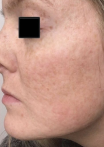IPL Photofacial Before and After Pictures in Colorado Springs, CO