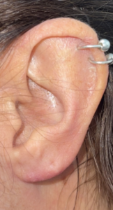 Earlobe Repair Before and After Pictures in Colorado Springs, CO