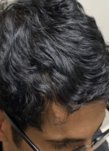 PRP Hair Restoration Before and After Pictures Colorado Springs, CO