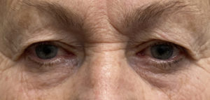 Brow Lift Before and After Pictures Colorado Springs, CO