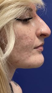 Filler Rhinoplasty Before and After
