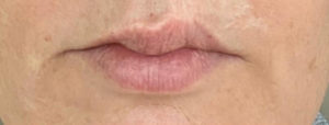 Lip Enhancement Before and After