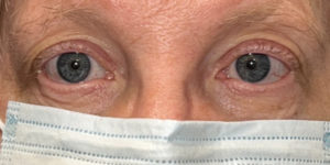 Hidden Incision Ptosis Before and After