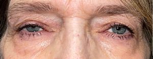 Bilateral Ptosis Repairs (Internal Approach) Before and After