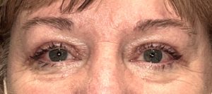 Upper Blepharoplasty and Brow Fat-Pexy - After