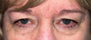 Upper Blepharoplasty and Brow Fat-Pexy - Before