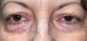 Ptosis - Internal Approach, Hidden Incision Before and After