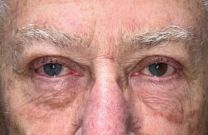 Bilateral Ptosis Before and After