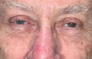Bilateral Ptosis Before and After