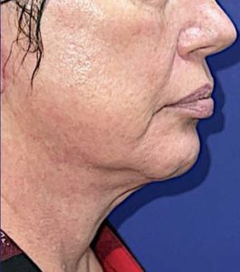 MyEllevate®, FaceTite, NeckTite, CO2 Laser Before and After