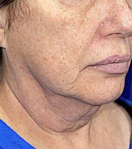 MyEllevate®, FaceTite, NeckTite, CO2 Laser Before and After