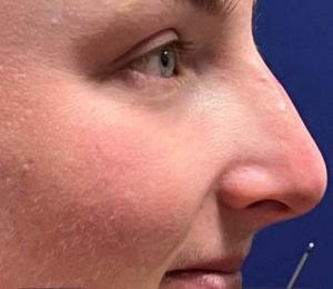 Filler Rhinoplasty Before and After