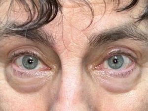 Hidden Incision Ptosis Repair Before and After