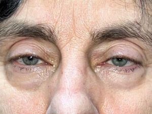 Hidden Incision Ptosis Repair Before and After