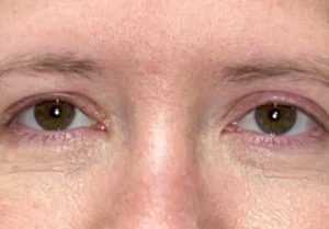 Internal Scarless Right Ptosis Surgery Before and After